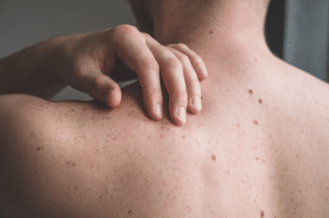 man's back with skin spots and moles - skin cancer