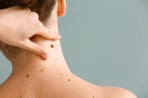 Woman neck mole - skin cancer
